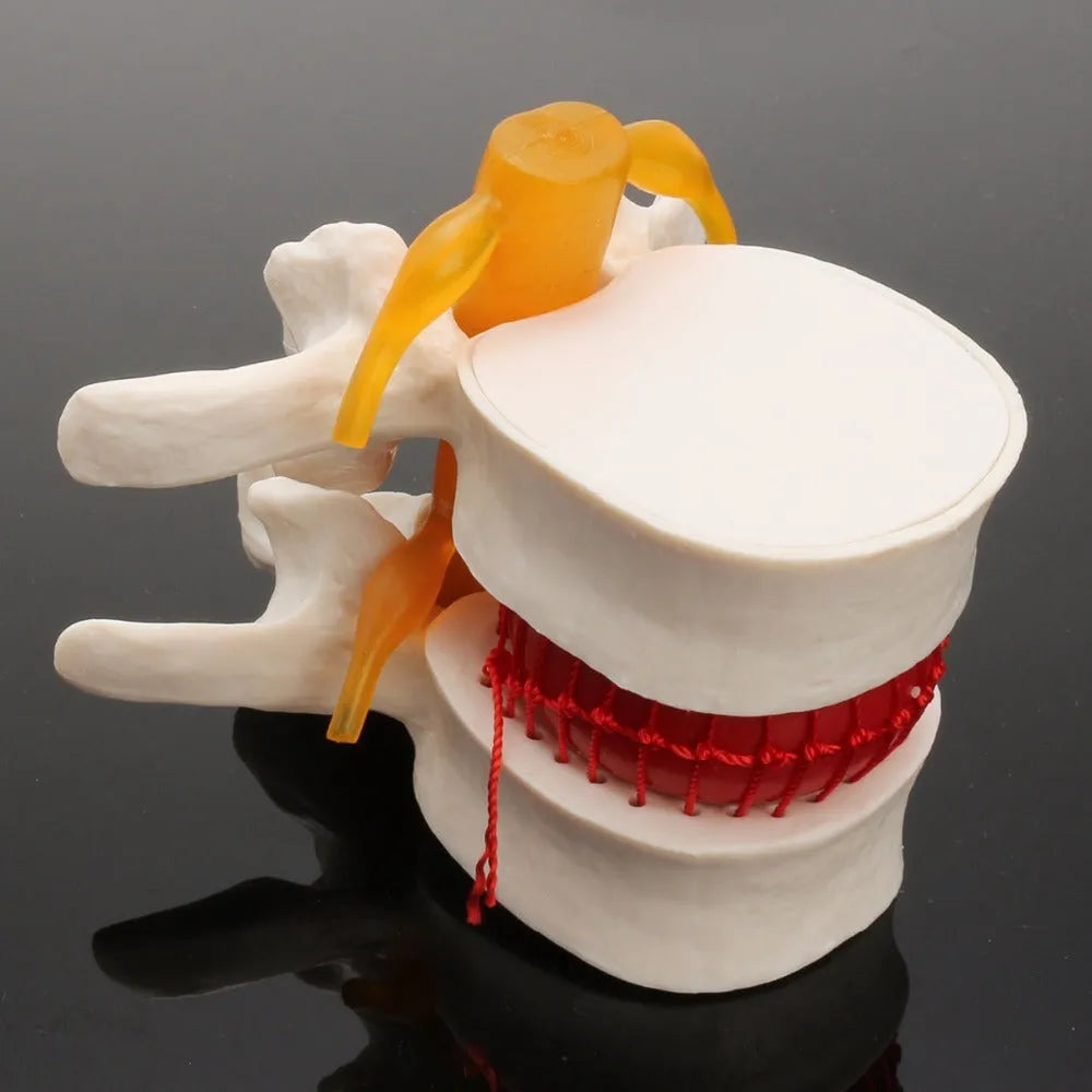 White PVC lumbar intervertebral disc herniation demonstration model showing anatomical details