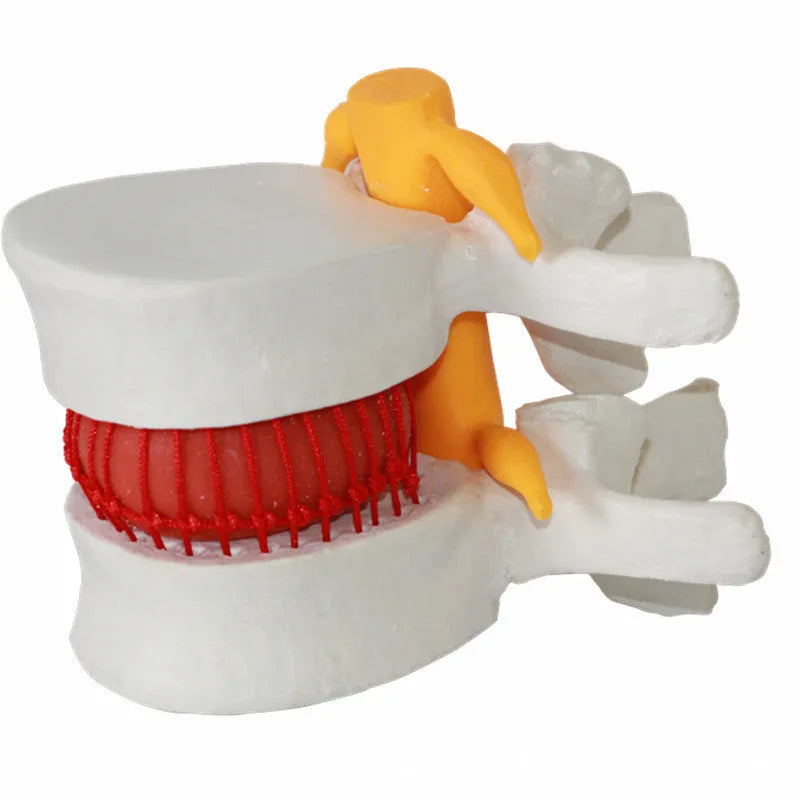 White PVC lumbar intervertebral disc herniation demonstration model showing anatomical details