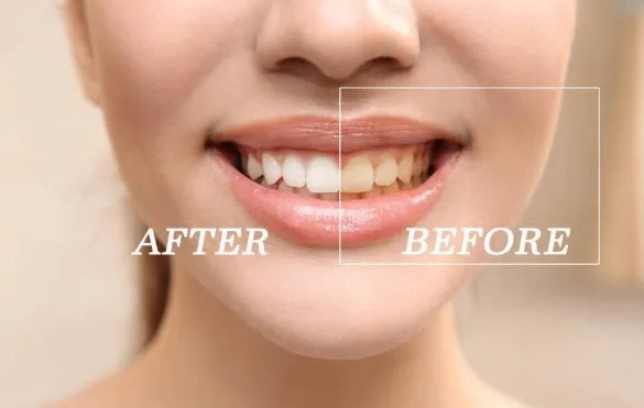 Teeth whitening kit with LED light and three 3ml gel sticks in blue packaging