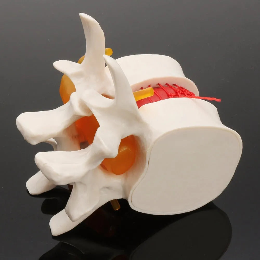 White PVC lumbar intervertebral disc herniation demonstration model showing anatomical details