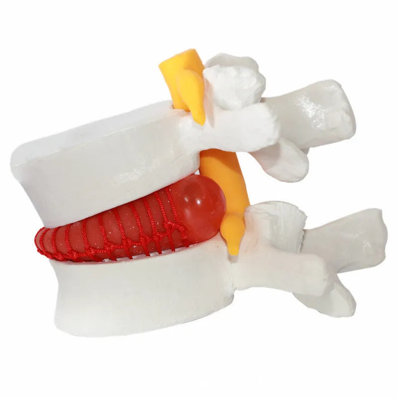 White PVC lumbar intervertebral disc herniation demonstration model showing anatomical details
