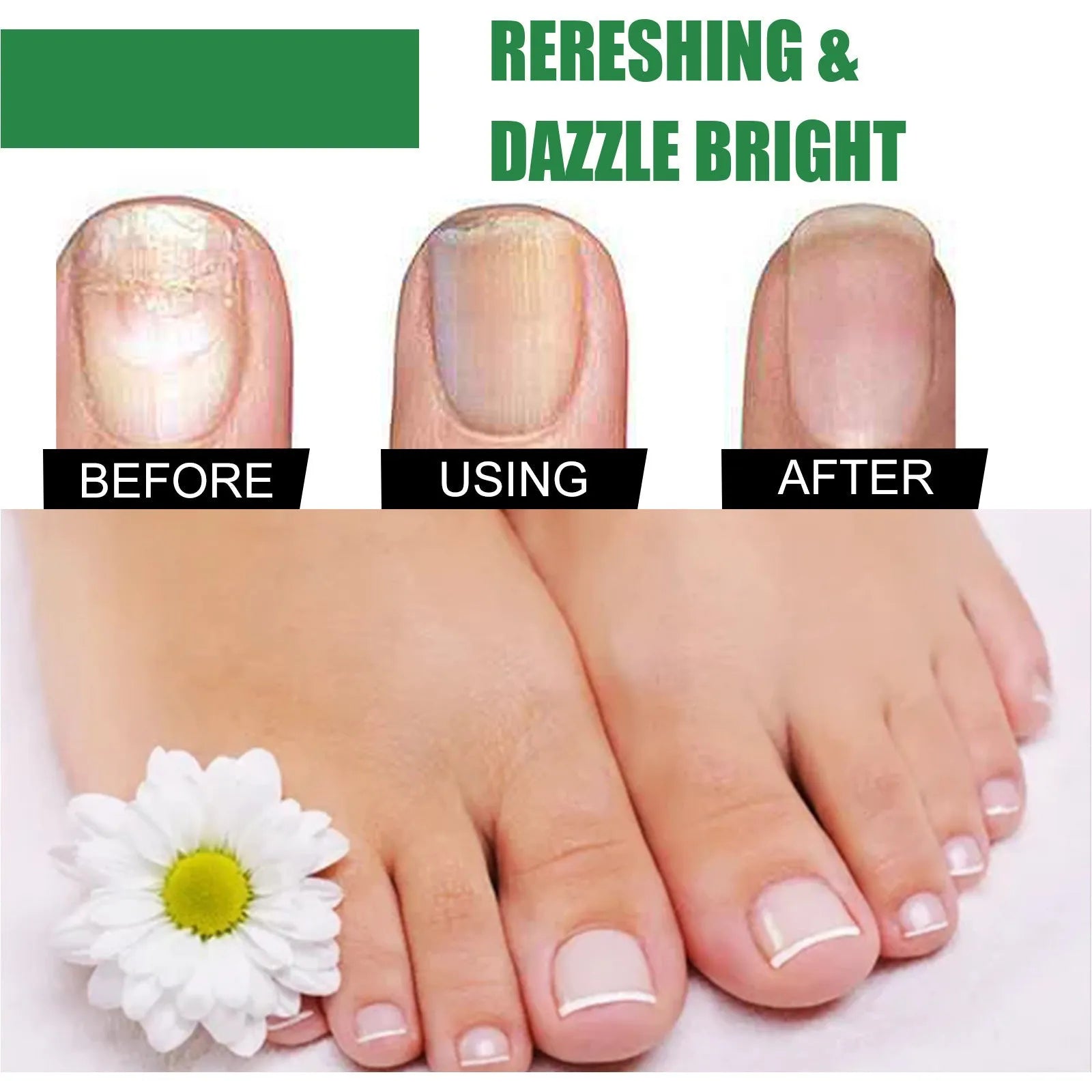 30ml bottle of tea tree oil foot and nail care solution for thick nail treatment