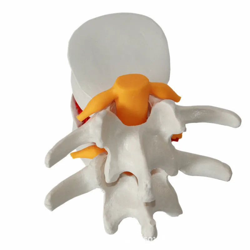 White PVC lumbar intervertebral disc herniation demonstration model showing anatomical details