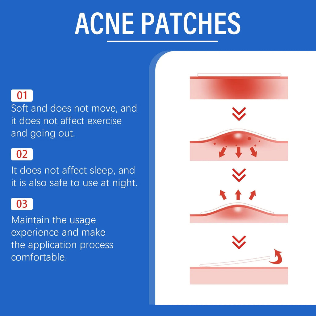 Acne patch sheet with 216 spots featuring Tea Tree Oil and Vitamin E for facial blemish care
