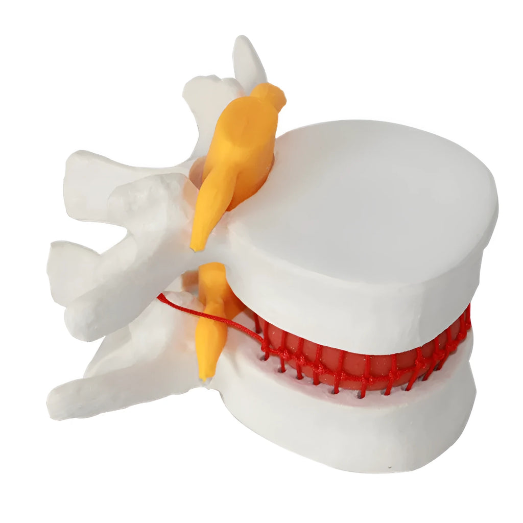 White PVC lumbar intervertebral disc herniation demonstration model showing anatomical details
