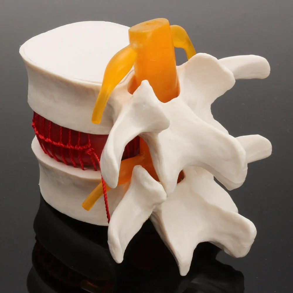 White PVC lumbar intervertebral disc herniation demonstration model showing anatomical details