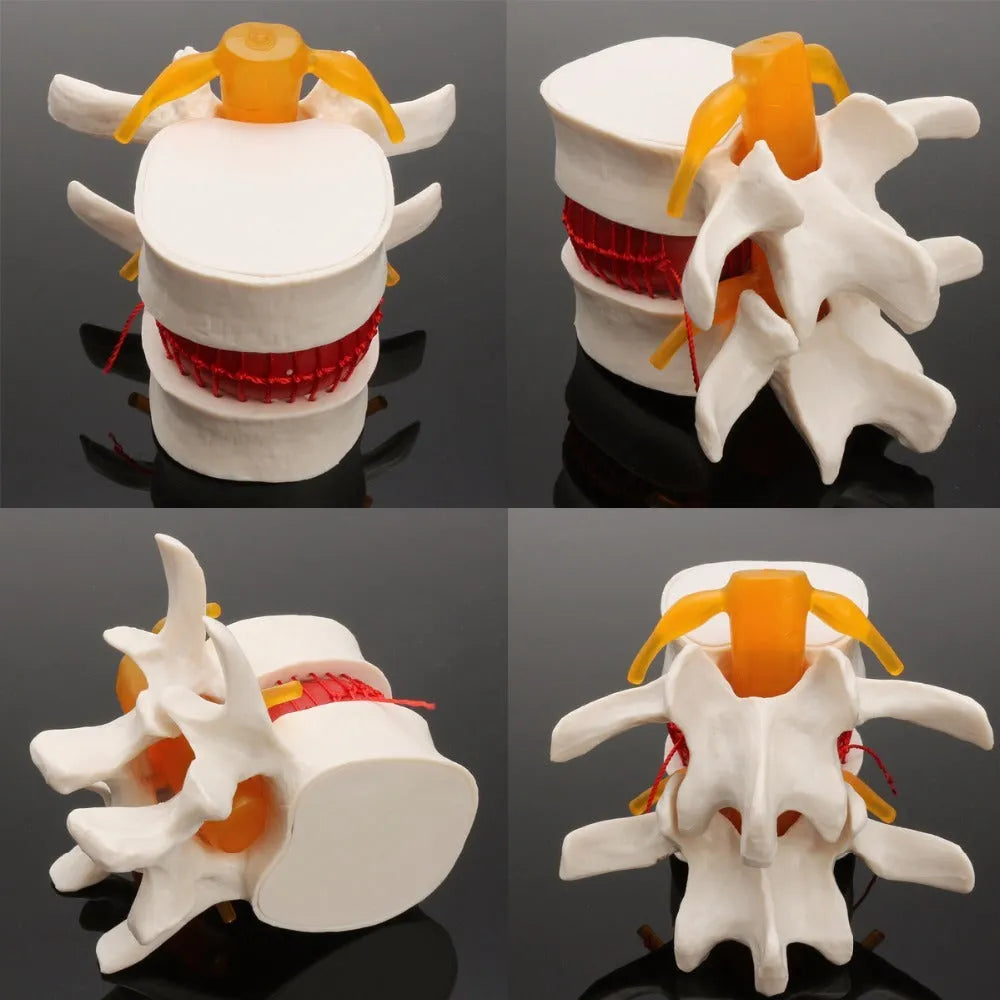 White PVC lumbar intervertebral disc herniation demonstration model showing anatomical details