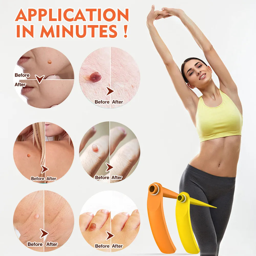 Orange yellow wart removal tool kit with rubber rings, removal devices and medical accessories