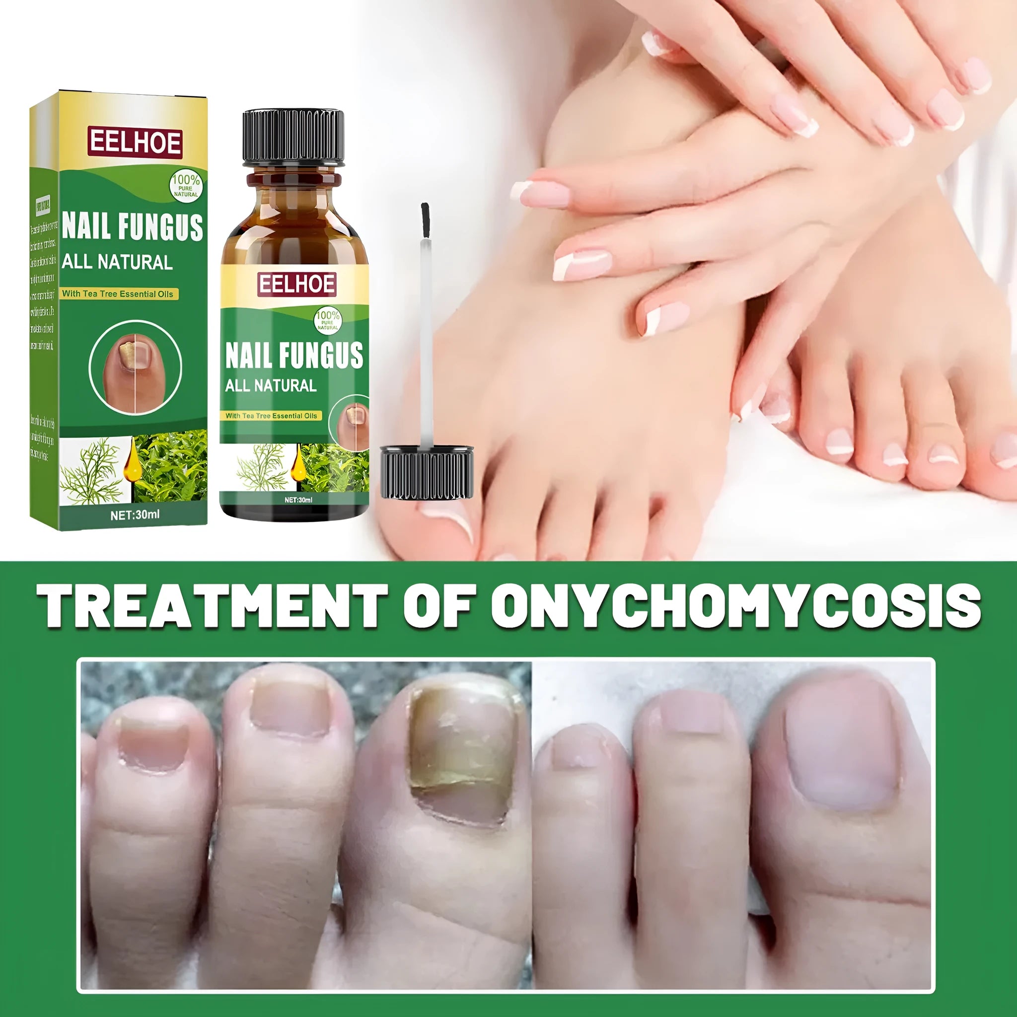 30ml bottle of tea tree oil foot and nail care solution for thick nail treatment