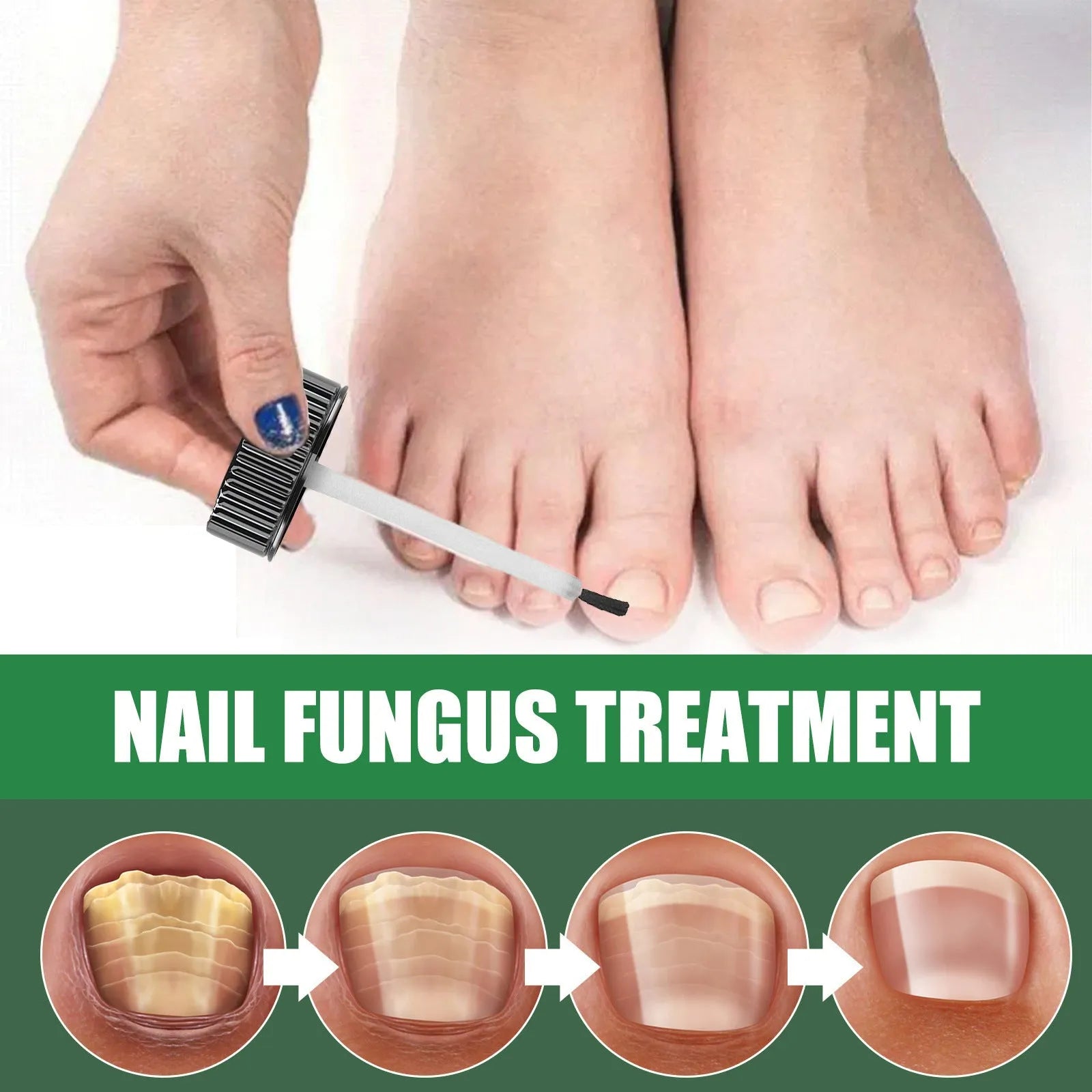 30ml bottle of tea tree oil foot and nail care solution for thick nail treatment