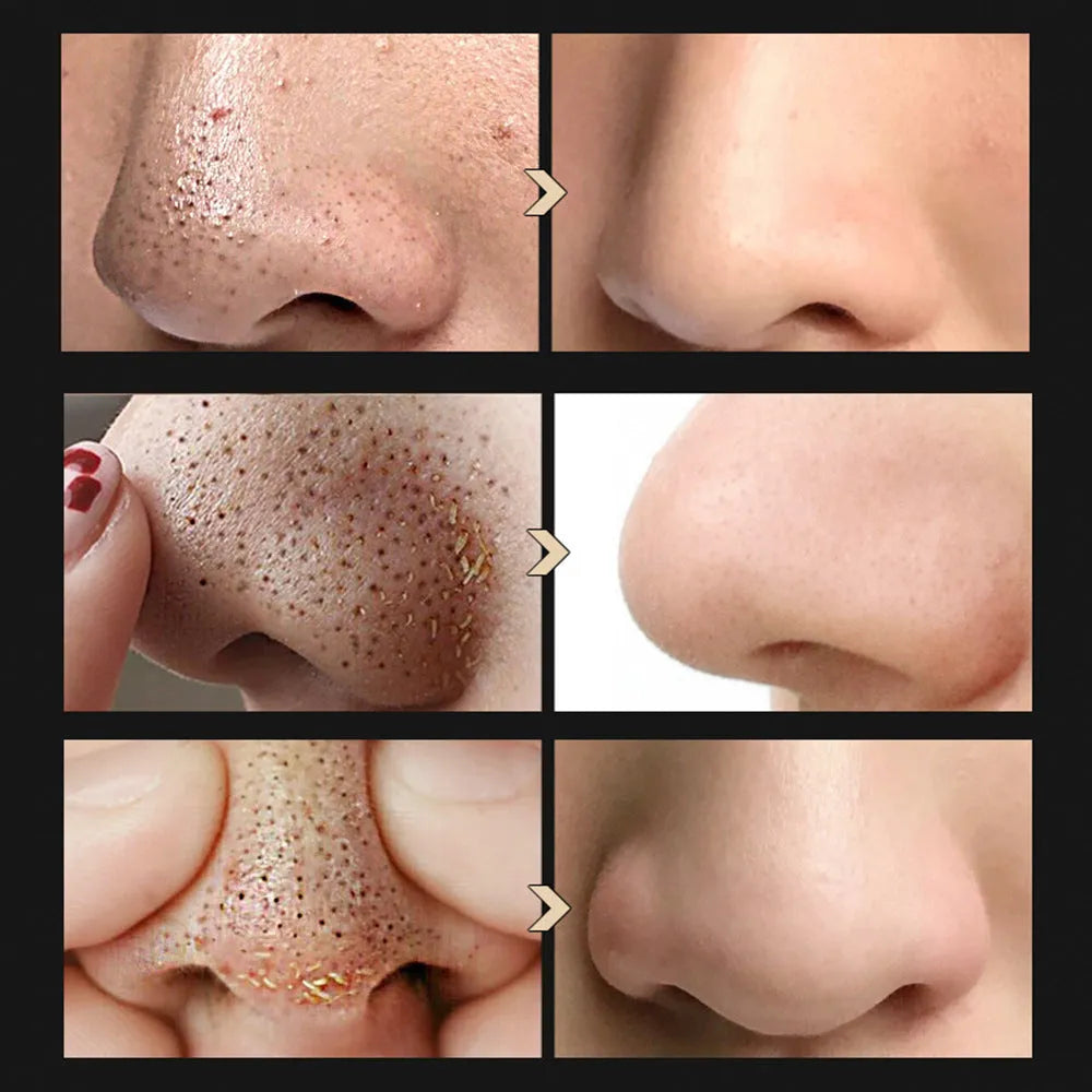 Blackhead Shrinking Combination Kit with Blackhead Nasal Liquid and Blackhead Shrinking Serum in Suit packaging
