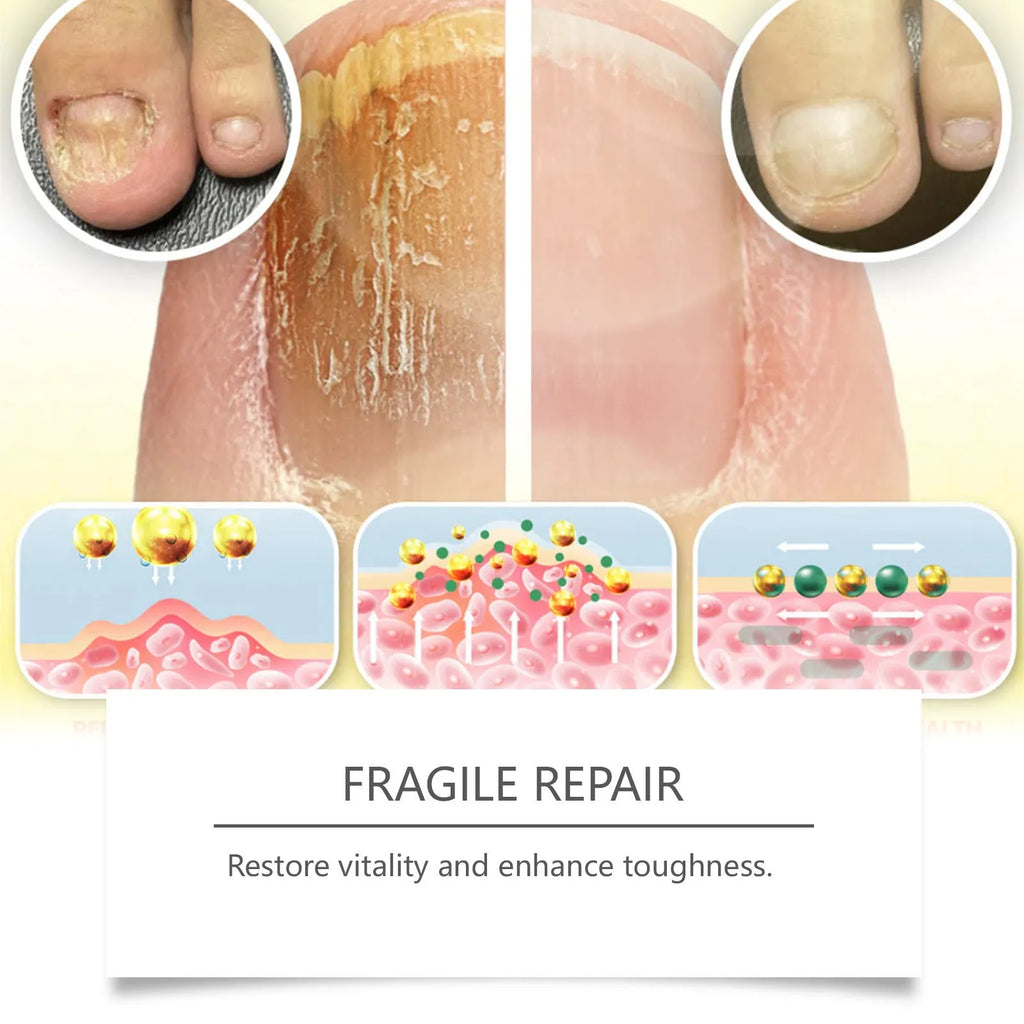 50ml bottle of nail care solution with bee venom and peppermint oil for fungal nail treatment